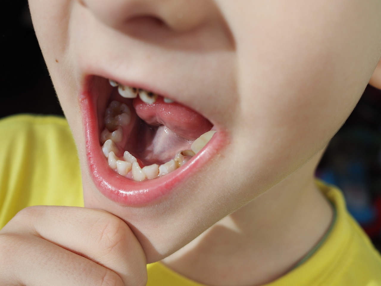 两岁多小朋友牙齿上有黑的怎么办？深圳小孩补牙多少钱一颗牙？