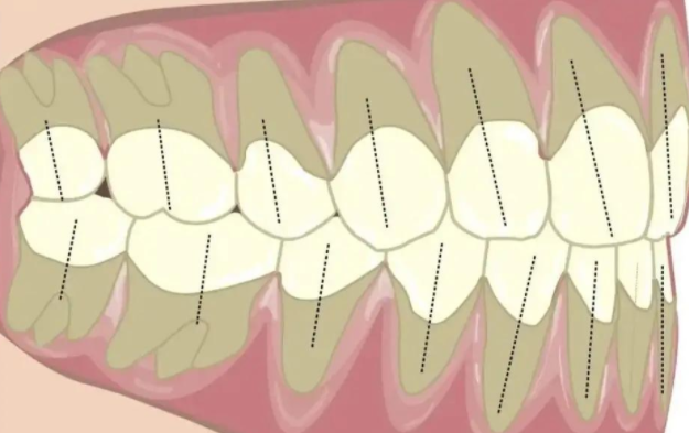 正常的咬合是怎样的