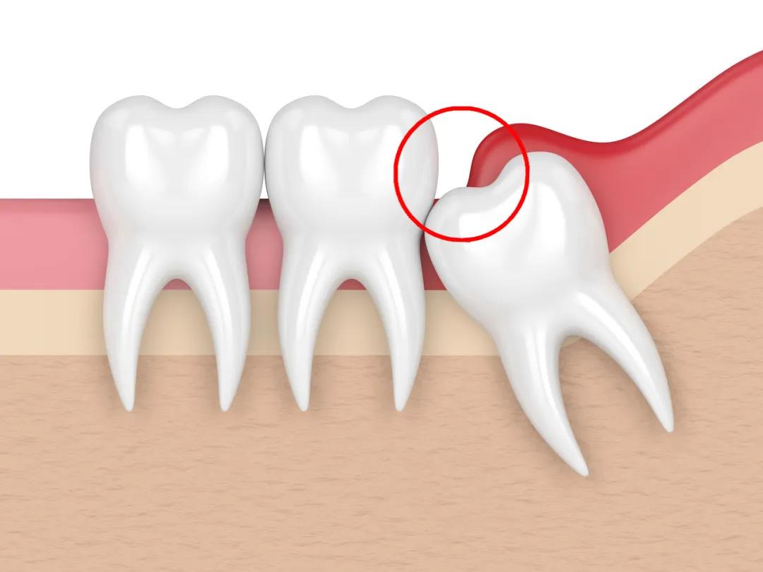 必须拔掉的智齿图