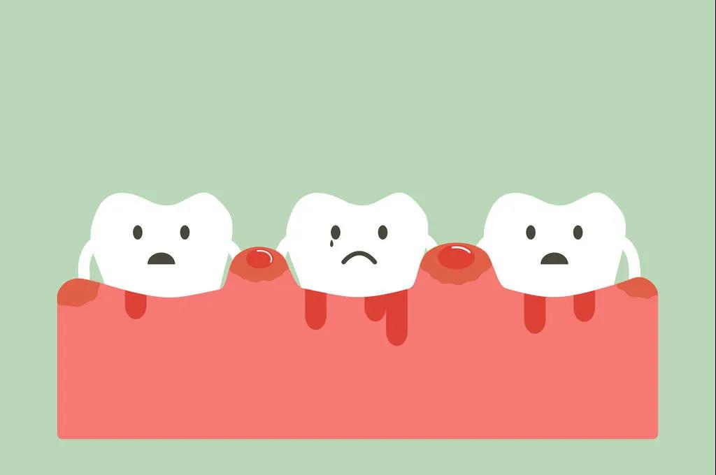 牙周病的五个阶段，你处于第几阶段？
