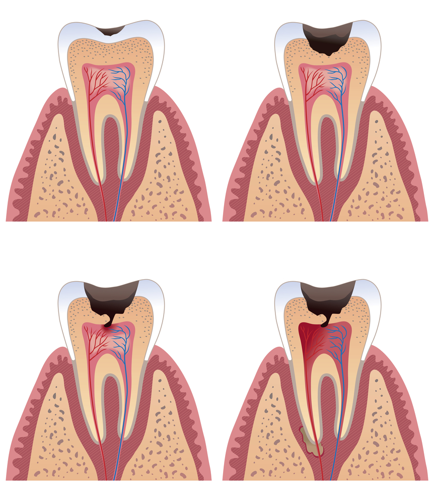 为什么牙齿吃东西就酸痛？牙齿酸痛该怎么治疗？深圳哪家医院看牙科比较好？
