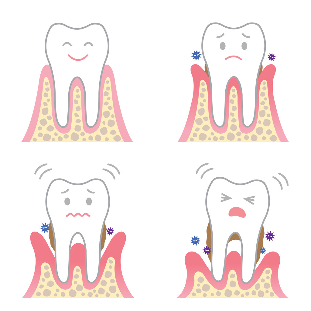 为什么牙齿会松动脱落？深圳哪个口腔诊所看牙好？