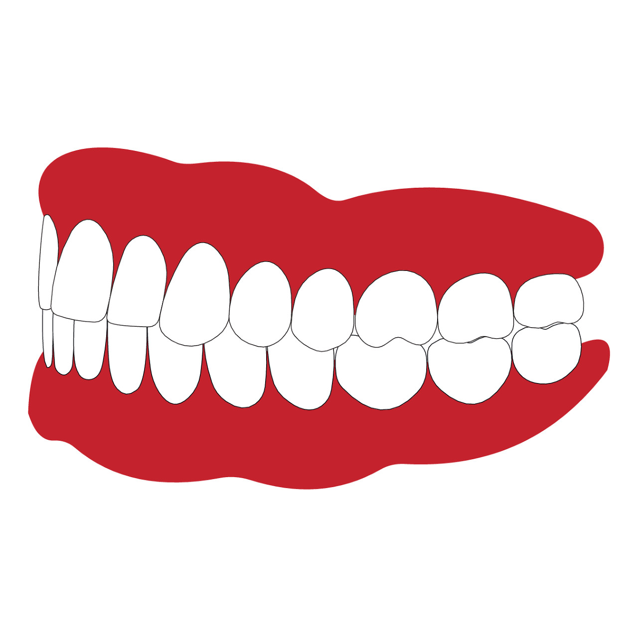 牙龈突出能不能矫正