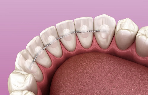 深圳牙科医院一般矫正牙齿多少钱