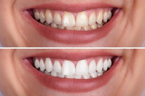 洗牙和牙周刮治到底有什麽區別