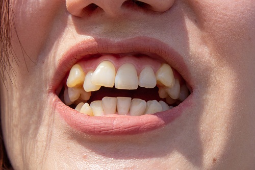 傳統金屬箍牙正矯期間的牙齒可以補牙嗎
