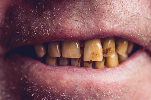 牙結石加煙垢洗牙多少錢一次