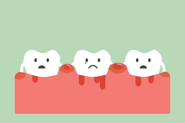 牙周炎和牙齦炎區別