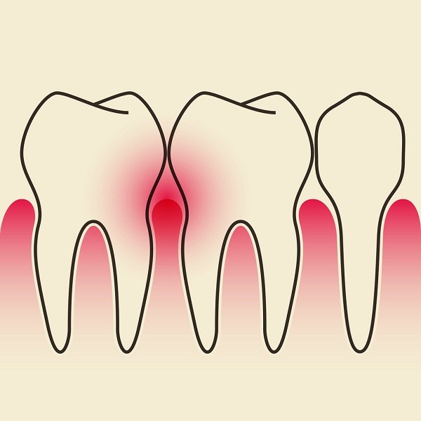 牙周炎病人可以装假牙吗