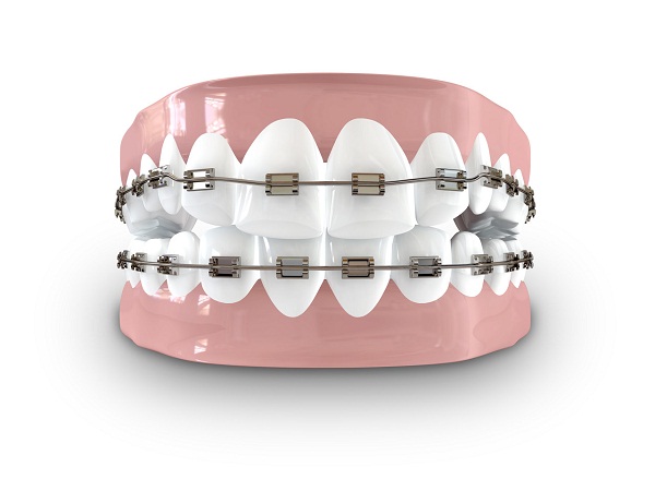 牙齒矯正分為幾個階段