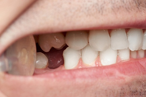 牙齒有殘根需要拔掉種牙嗎