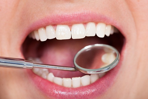 洗牙同牙周刮治區別