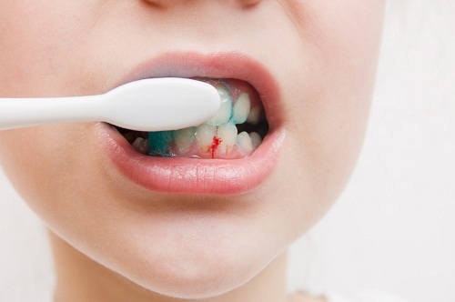 洗牙和牙周刮治区别