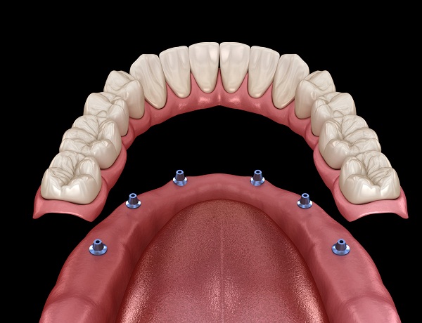 深圳全口種植牙費用