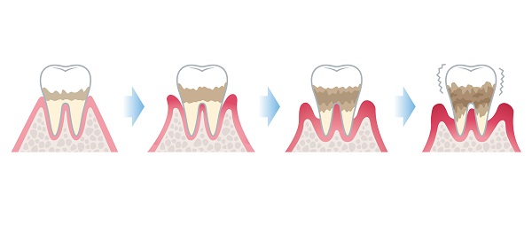 深圳牙周病治療