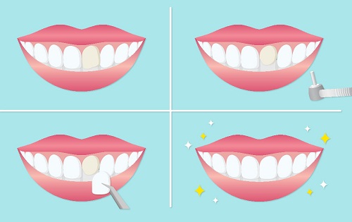 做了牙齒貼面可以洗牙嗎