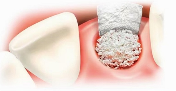 骨量不足怎么辦