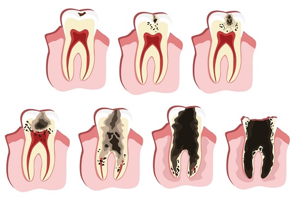 北上補牙安全唔安全
