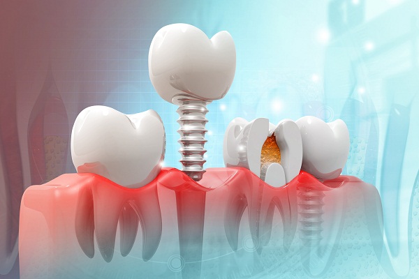 長期缺牙還能不能做種植牙