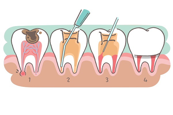 拔牙和重做根管治療該如何選擇