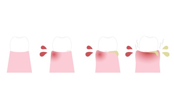 牙周炎需要做手術嗎