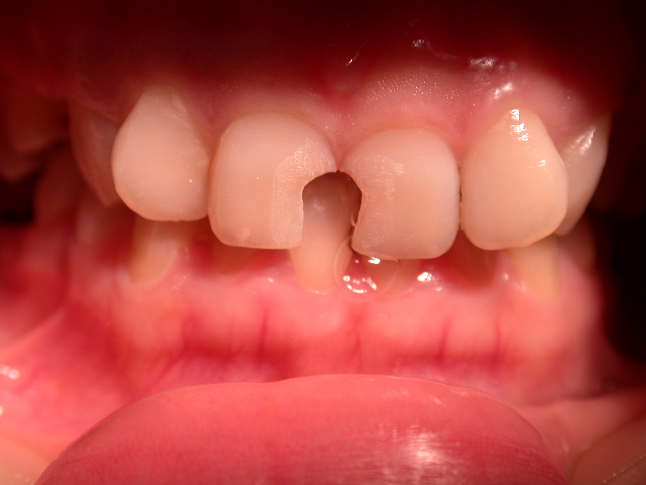 补牙越早越好吗