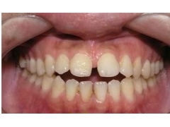 矫正前牙开颌的最佳时间是什么时候?