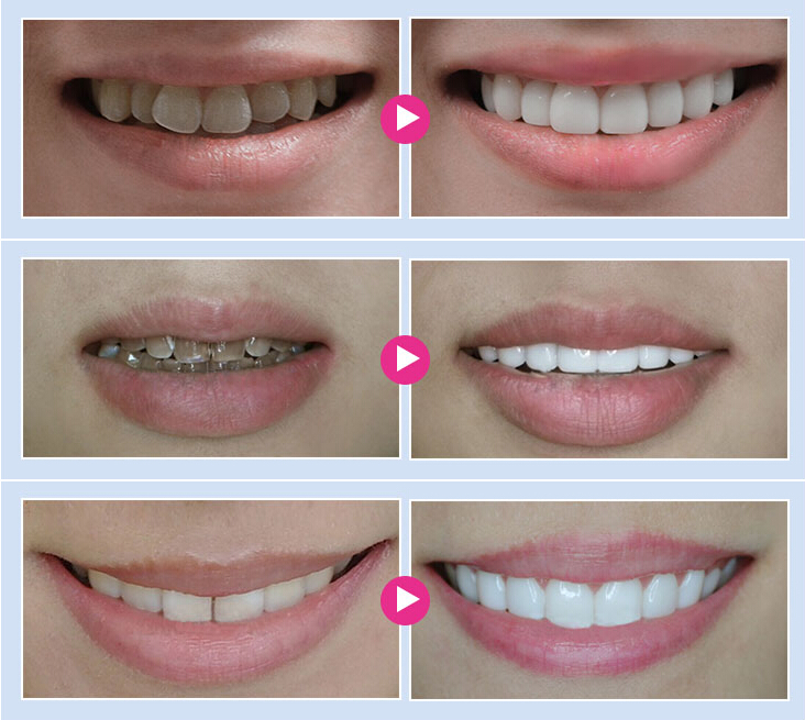 仿真效果:瓷贴面仿真的美容效果,具有与天然牙体组织相同的光学特质