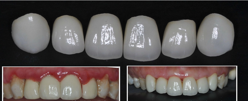 瓷贴面美白牙齿效果如何