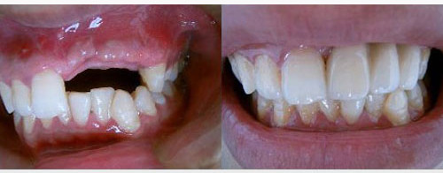 拔牙后多久装假牙比较合适?