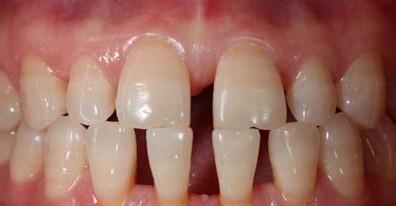 成年人牙齿缝隙大怎么治疗