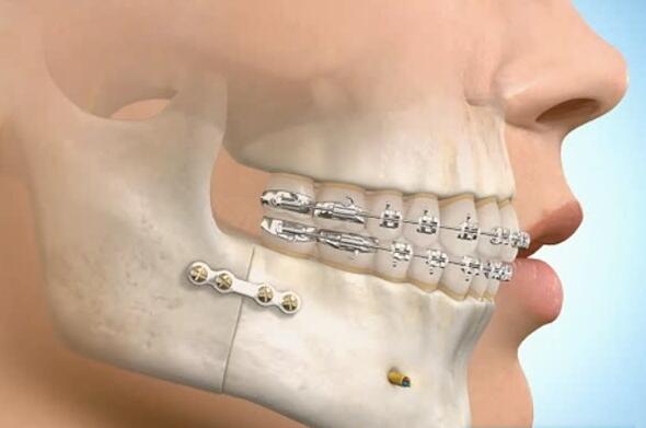 牙齿矫正什么时候做较好