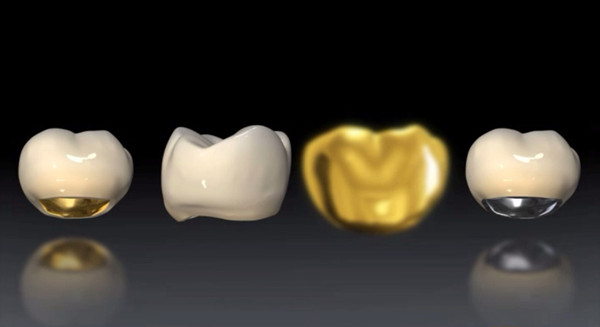 全瓷美容冠价格多少