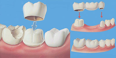 做完烤瓷牙后牙疼是没做好吗怎么办